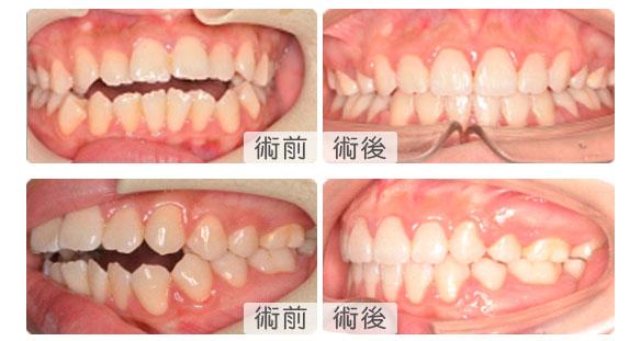 深圳错颌开颌牙齿矫正案例分享