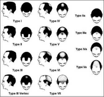 2,对于女性来说:女性脱发呈弥漫性脱发,具体表现为头发变细和密度下降