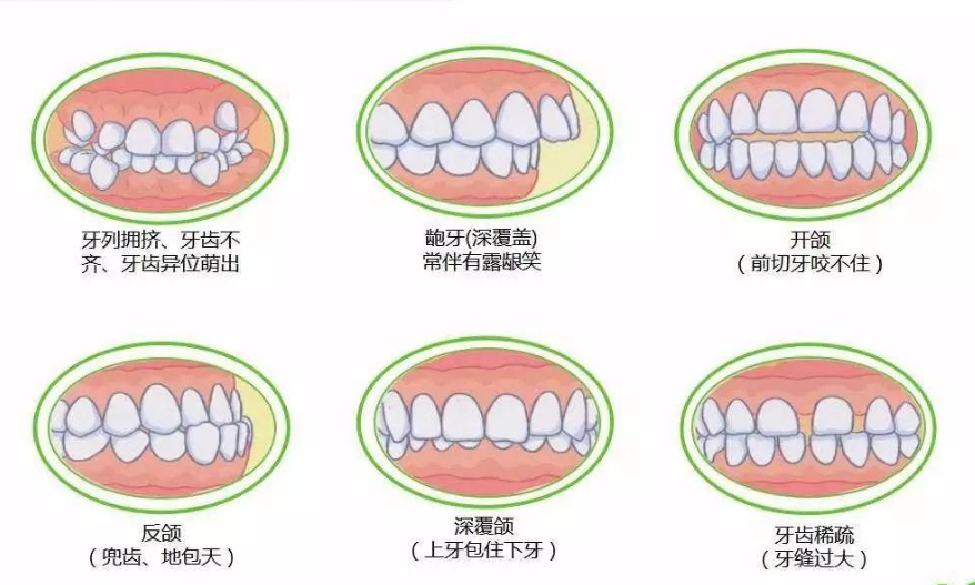 70中国儿童都出现的牙齿不齐父母应该如何早期干预