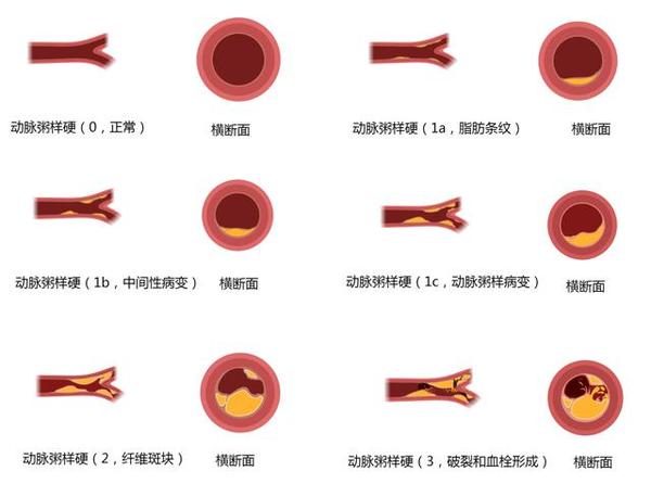 08 动脉粥样硬化