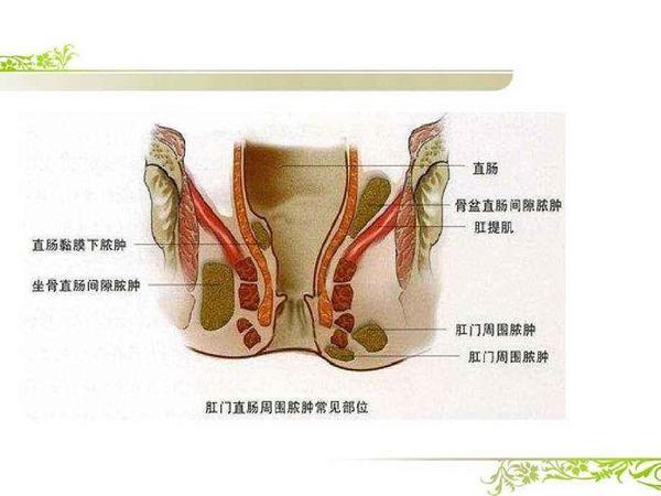 长在肛门周围的"囊肿"不一定就是粉瘤, 还可能是肛瘘啊