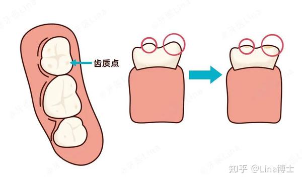 齿质点是牙齿咬合面的牙釉质磨损之后暴露出的点状牙本质.