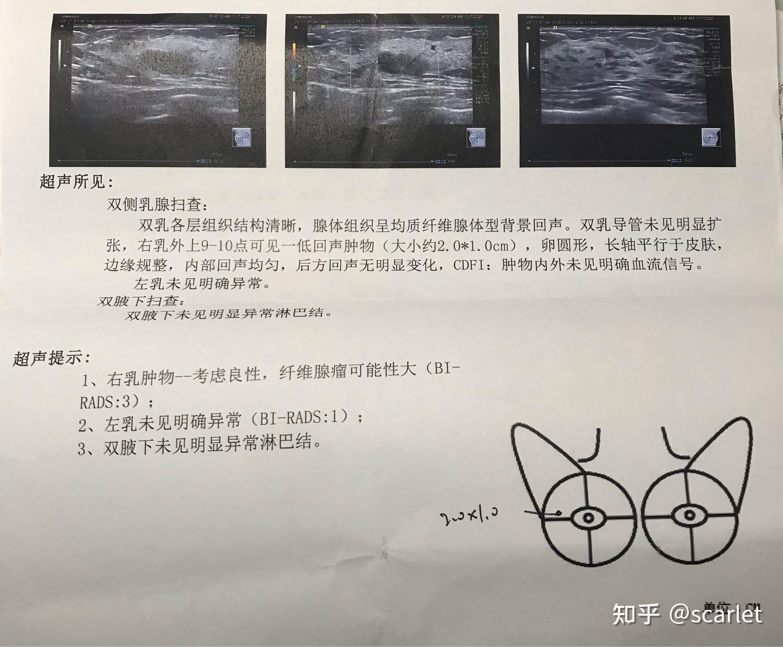 工作后,公司有了每年定期体检,第一年查出乳腺增生,听大家说基本女生