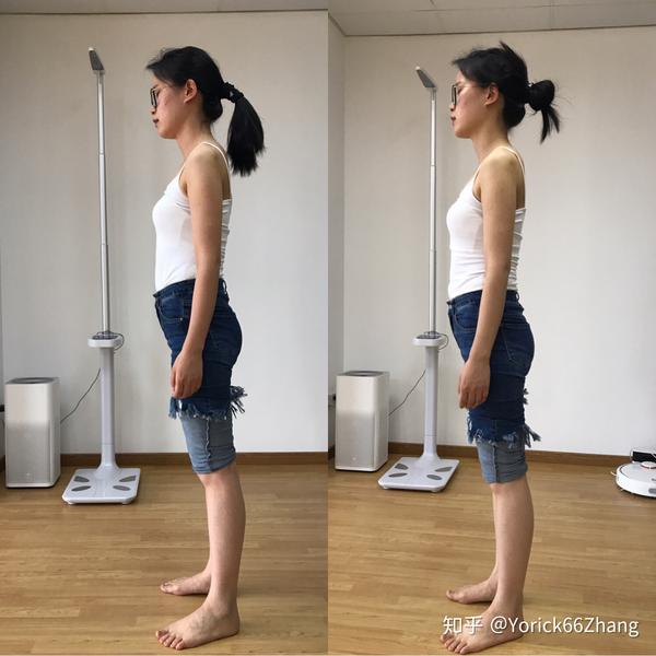 脊柱侧弯案例分析:3个月减少5°(附x光片,训练建议)