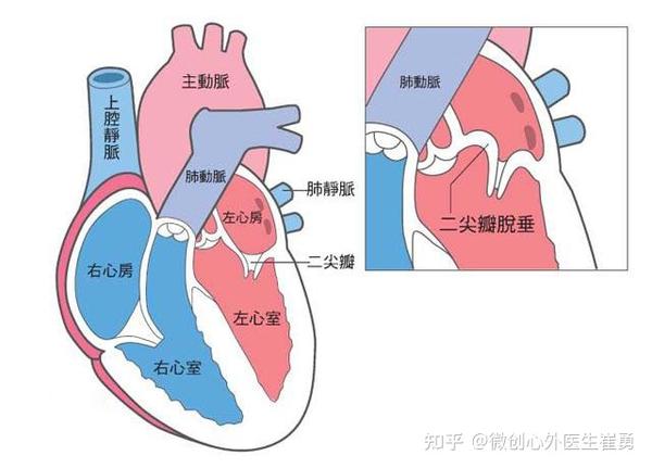 杭州治疗二尖瓣关闭不全,浙江省人民医院通过腋下心脏