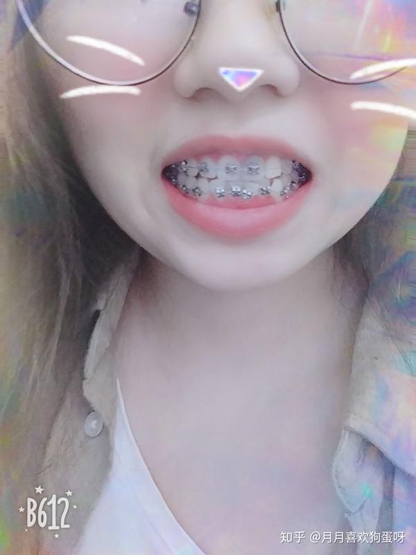 大龄女青年,牙齿正畸并拔牙的过程和感觉?