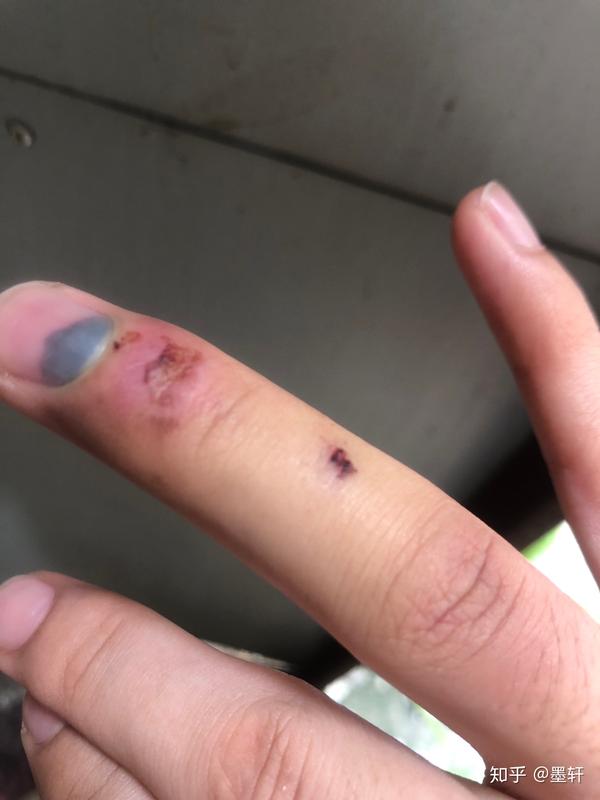 手指被夹到,指甲里边充血,手指肿了.现在捏的时候骨头有一点痛.