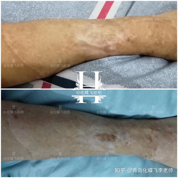 湖南岳阳,2008年胎记植皮手术,缝合增生疤痕.