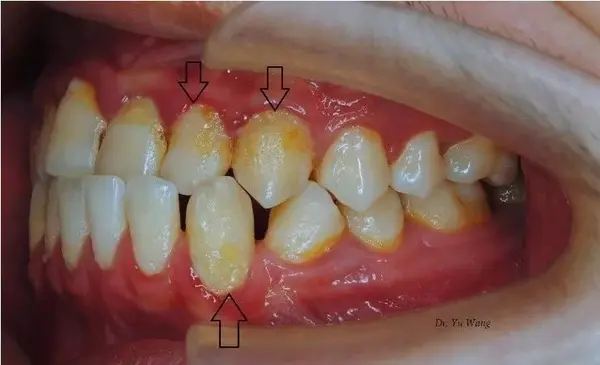 不良口腔卫生习惯导致的牙面软垢堆积,牙齿发黄
