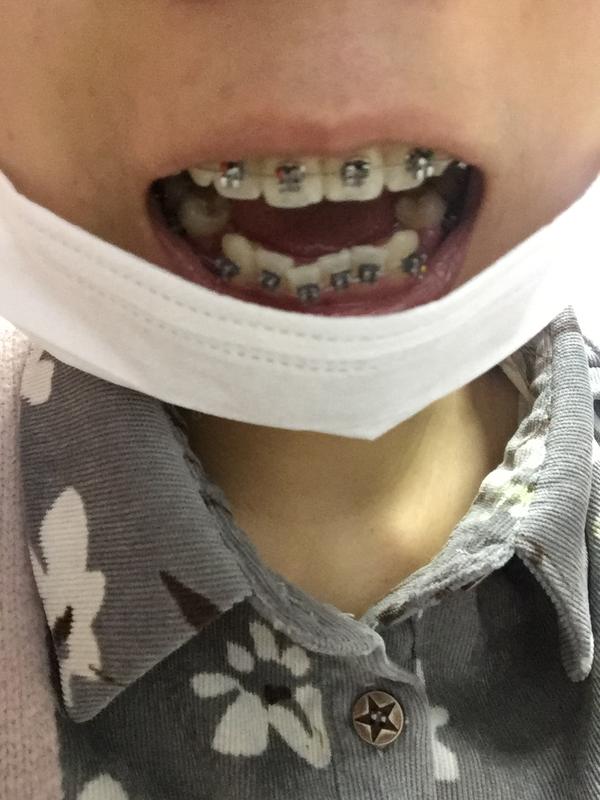 刚戴牙套时候哈达在家里放法图片
