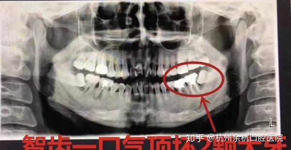 牙医警示 "看牙"第一步,为什么要拍片?