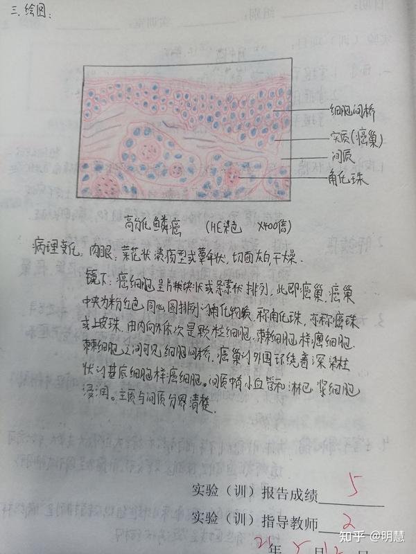          高分化鳞癌