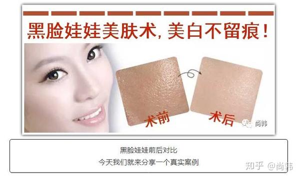 黑脸娃娃前后对比案例分享