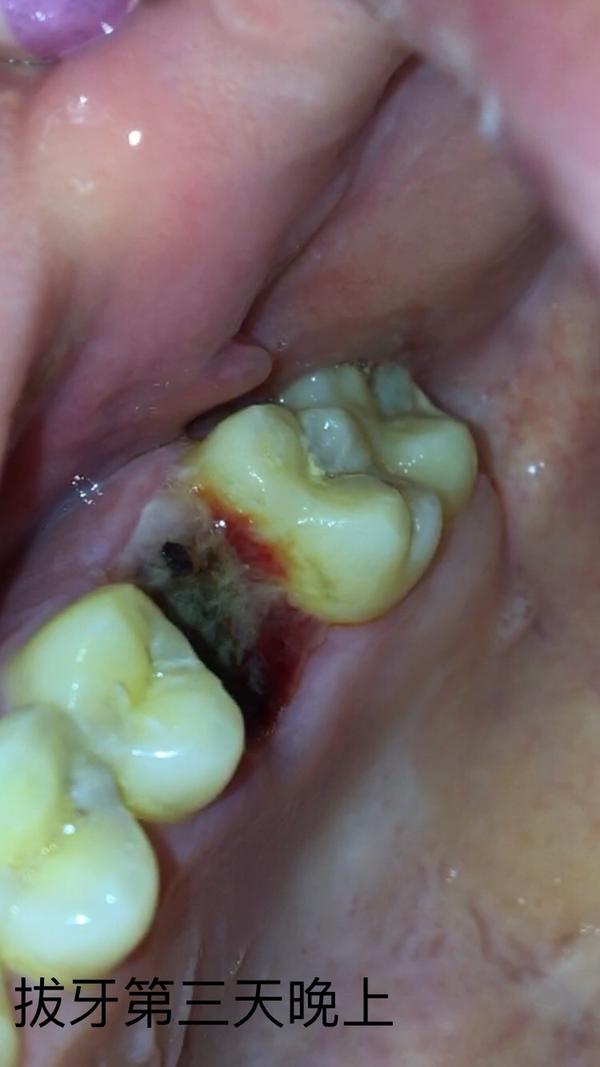 拔牙全程(多图慎点)恢复期全过程
