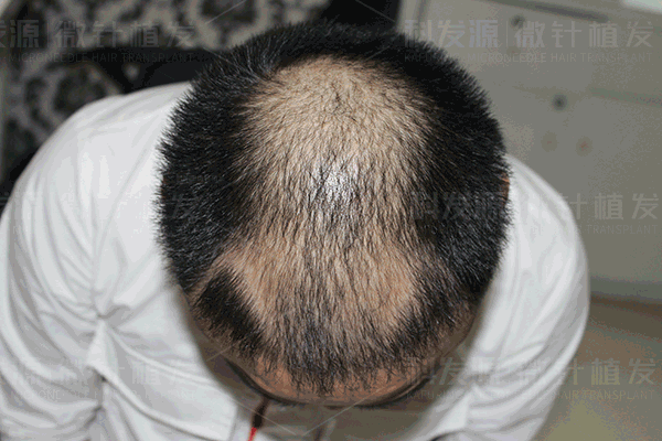 微针植发费用贵不贵?根据什么计算?