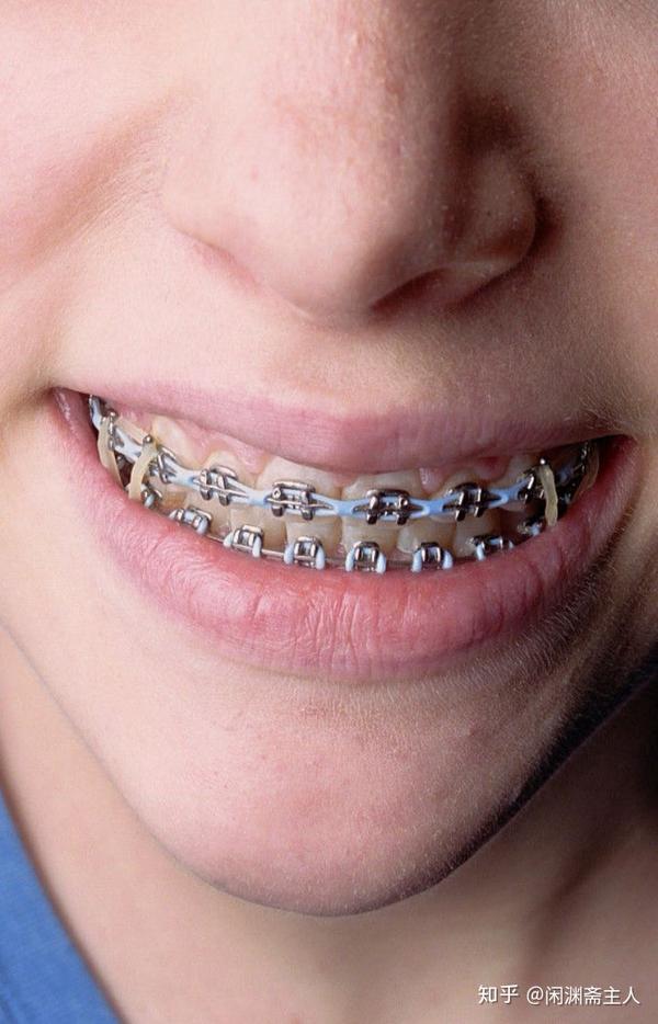 牙医在安装牙套前需要拔出所有已经坏死的龋齿,因此戴钢牙套的时候