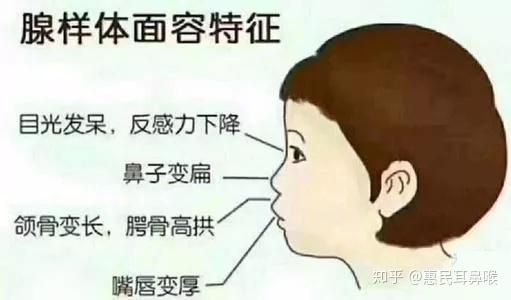 鼻炎反复不好竟是腺样体肥大惹的祸?