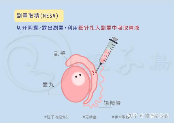 副睾取精(mesa):切开阴囊,露出副睾后,利用细针扎入副睾中吸取精液.