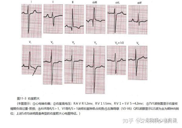 逆钟向转位心电图 zhuanlan.zhihu.com