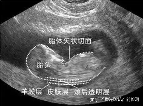 nt检查又称颈后透明带扫描,是通过b超手段测量胎儿颈项部皮下无回声