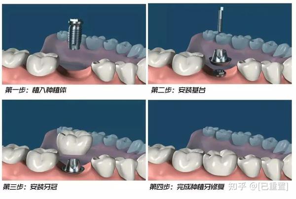 种植体和牙龈很好地融合后,它也非常稳定并且不容易松动.