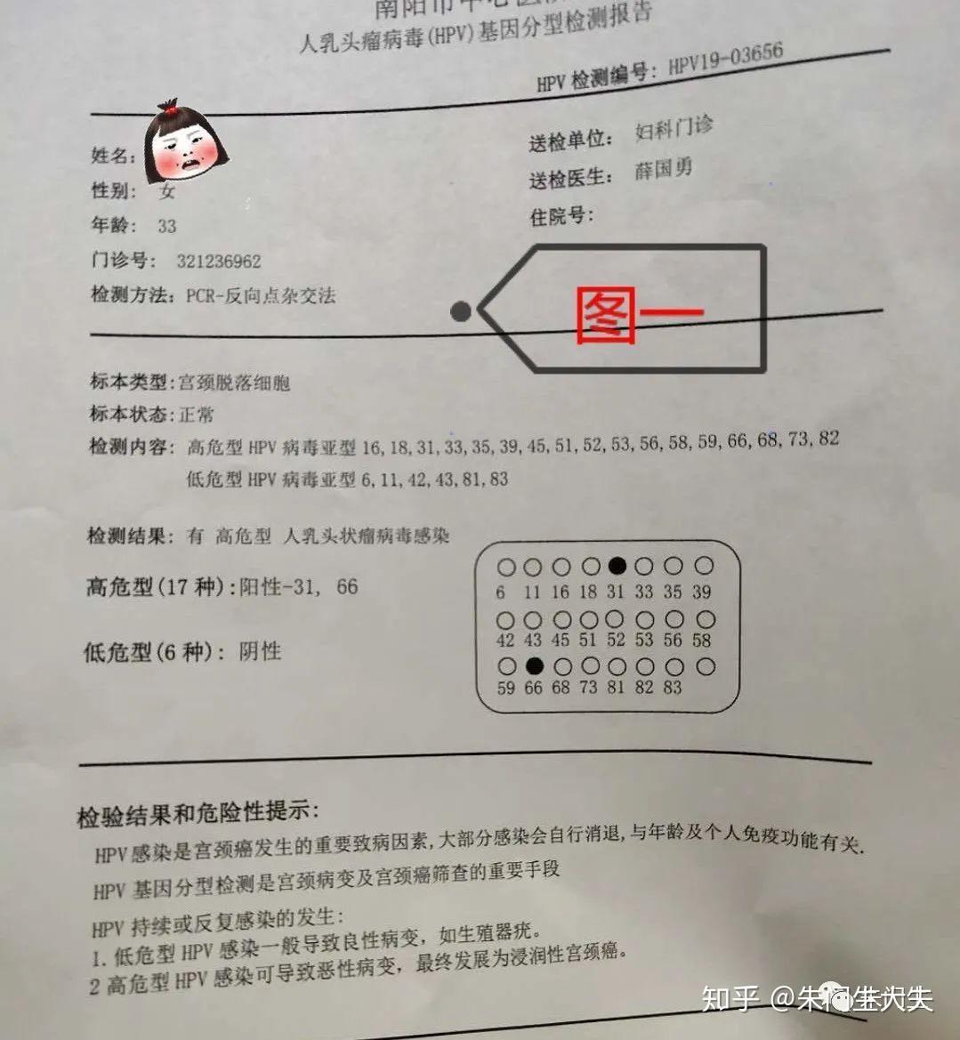 南阳市高女士hpv31hpv66型高危转阴病例分享