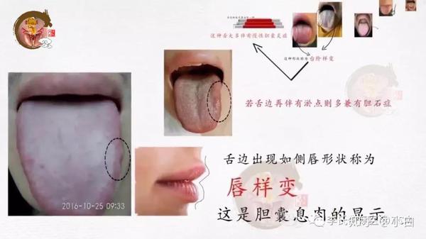 舌边与肝胆奇效舌诊动画配图文版