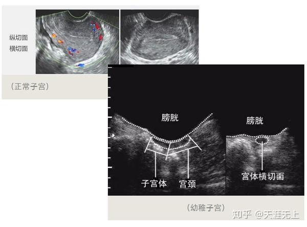 什么是幼稚子宫?可以做试管婴儿怀孕吗?