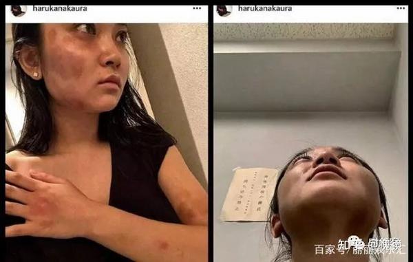 中浦悠花被家暴后造成的伤痕(脸上似乎是脚板印)