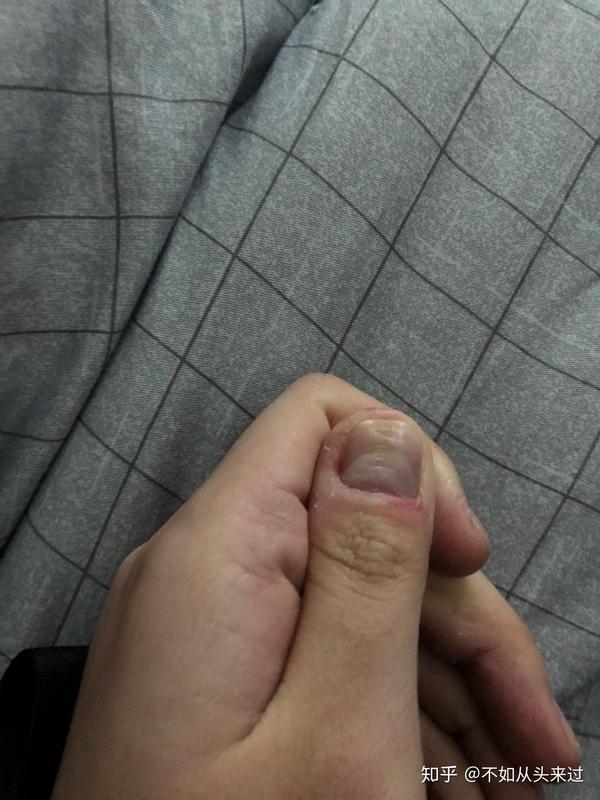 大拇指指甲凹凸不平有凸起的横纹和凹陷很多年了也没有其它问题去检查