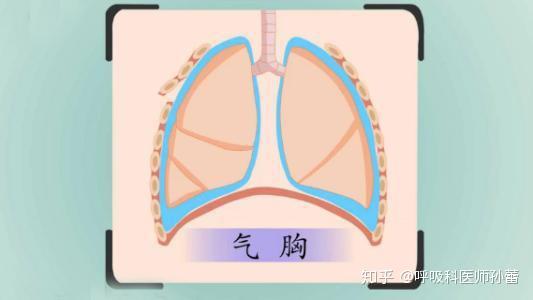 深受气胸困扰中医可以帮助你