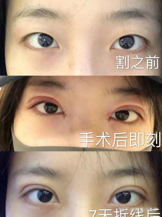 促进伤口的愈合,别急着化妆,需在伤口完全恢复后,以免使切口裂开