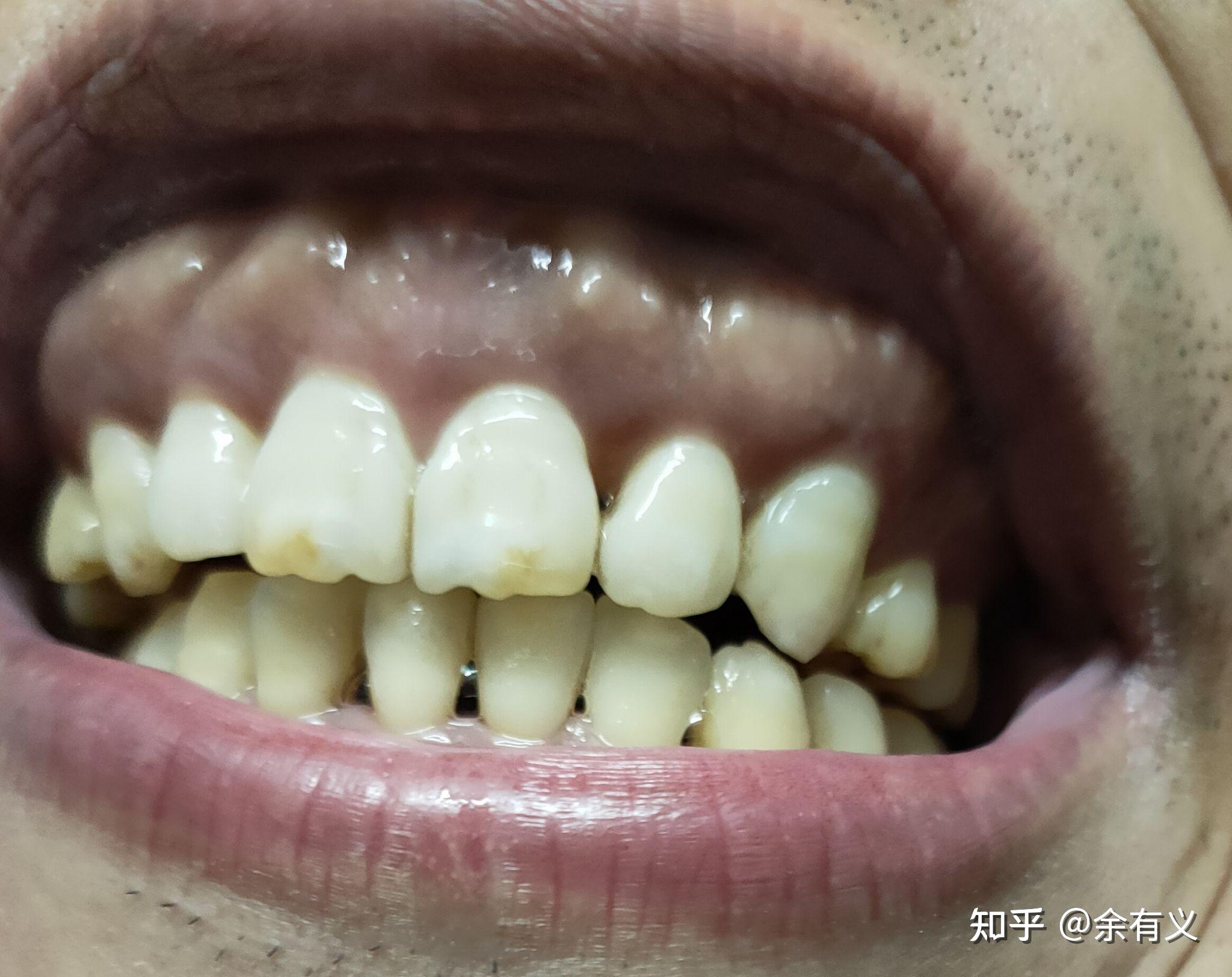 广东省口腔医院害本人牙齿正畸历时6年并以失败告终致本人8颗牙舌侧牙