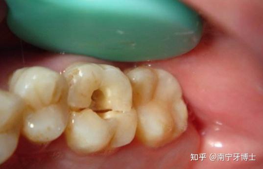 牙神经外露图片 zhuanlan.zhihu.com