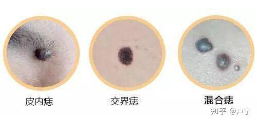 皮内痣:痣细胞只存在于真皮层,凸起,颜色接近肤色.