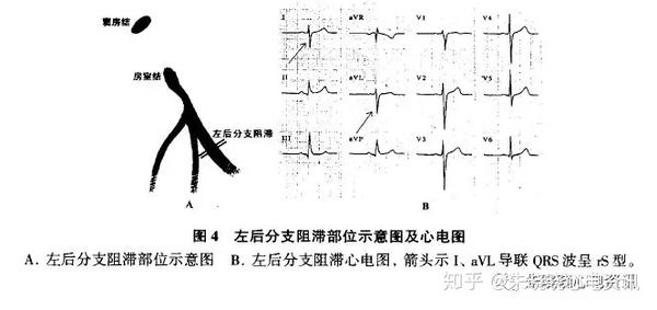 临床诊断左后分支阻滞时