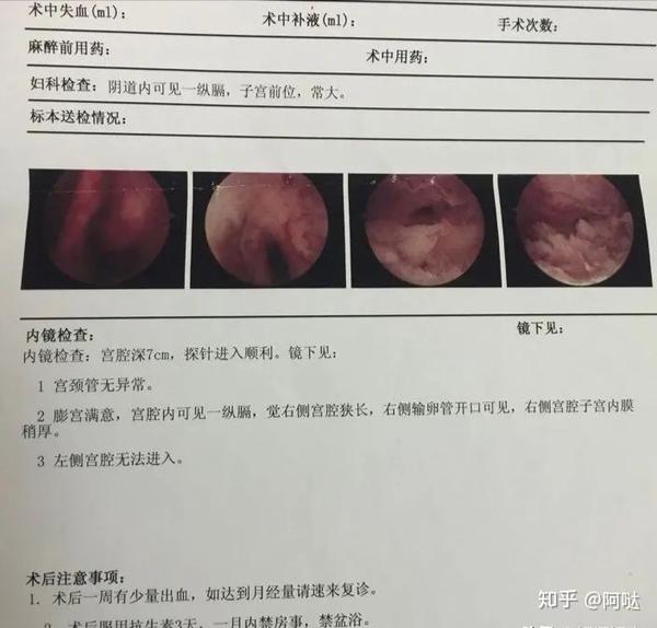 做宫腔镜检查痛不痛