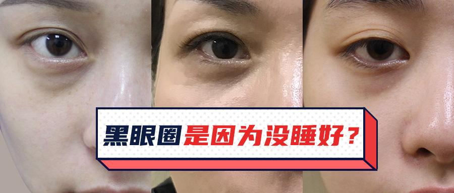 黑眼圈分为色素型,血管型,结构型以及混合型,不同类型黑眼圈的"治疗"