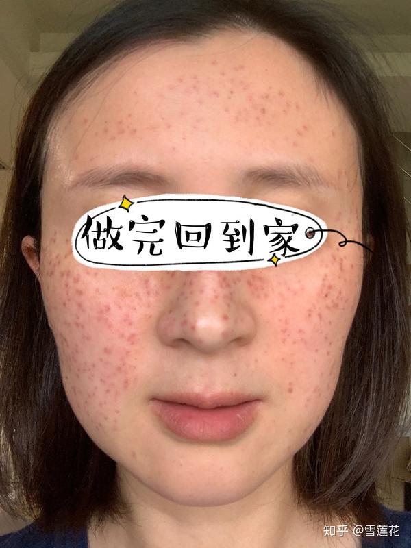 记录第一次超皮秒祛斑英诺小棕瓶