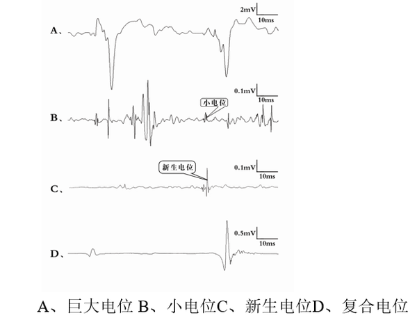 "传说"的肌电图emg?