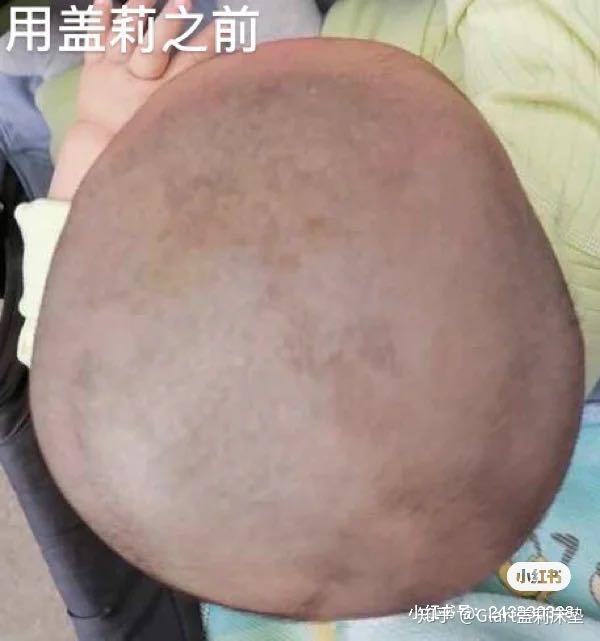 八个月扁头又偏头的宝宝,头型变没变?
