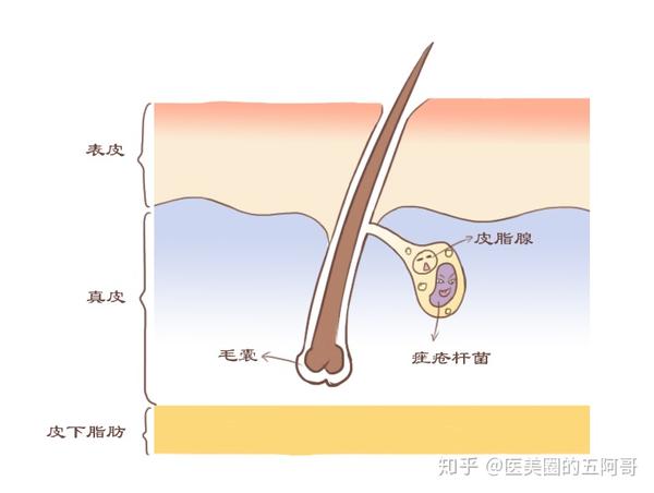 痤疮是毛囊皮脂腺单位的一种慢性炎症性皮肤病.