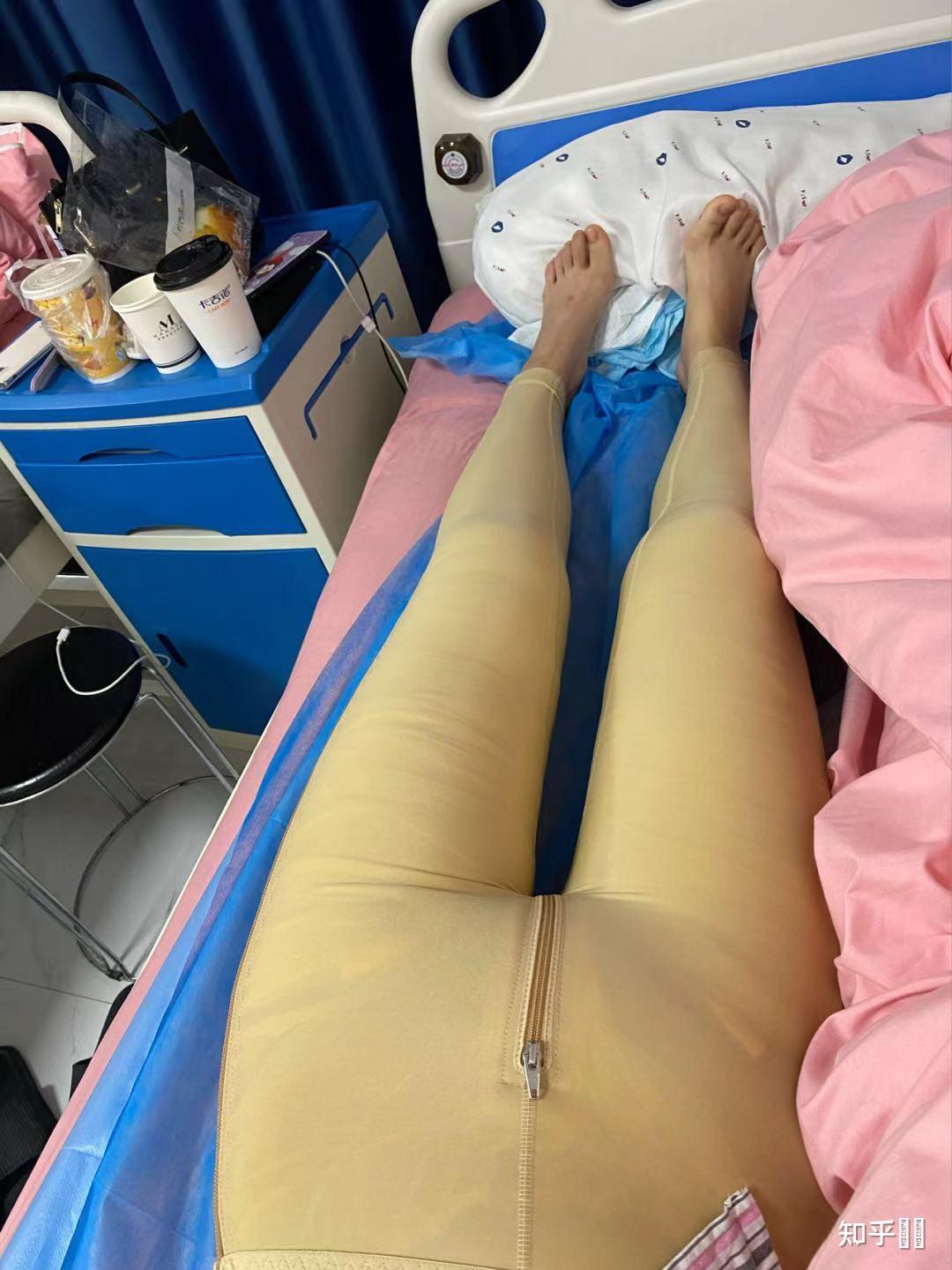抽脂瘦小腿 知乎