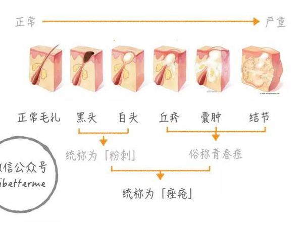 毛孔堵塞之后,皮肤的皮脂却不会停,于是慢慢会形成一个 「脂质栓」,就