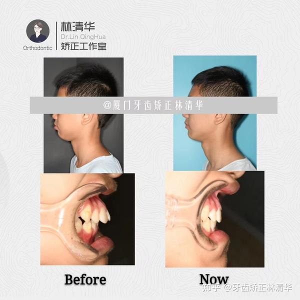 厦门牙齿矫正林清华:『孩子牙不齐 矫正越早 效果越好