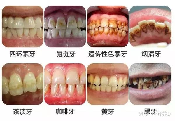 2, 重度的四环素牙,氟斑牙,或者其它因素引起的变色牙(部分中度的