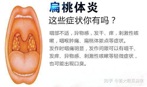 首大眼耳鼻喉医院石萍:到底要不要对扁桃体"动手"呢?