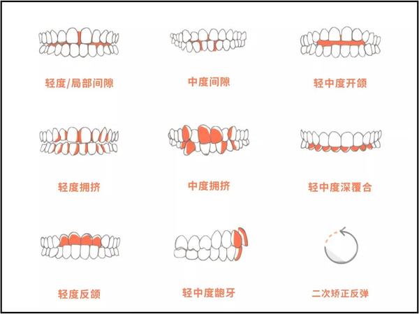 牙齿稀疏,牙齿拥挤,牙齿不齐,龅牙,地包天等错颌畸形……都可以做隐形