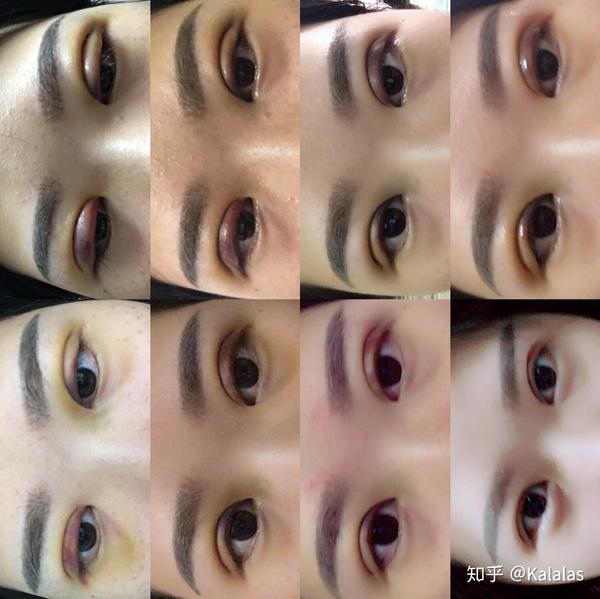 割双眼皮失败是什么样子的?