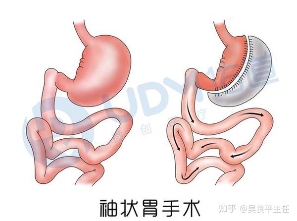 胃袖状切除术能报医保 袖状胃切除能报医保么